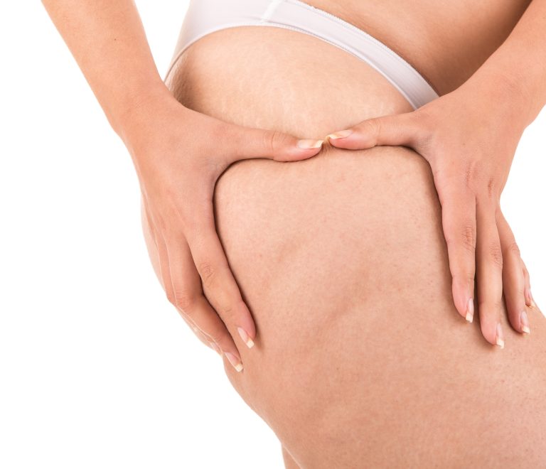 Cellulite Behandlung